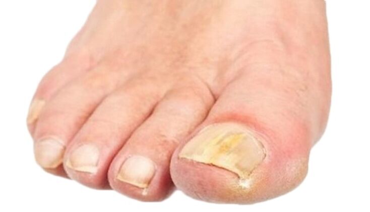 Micosi che distrugge le unghie dei piedi
