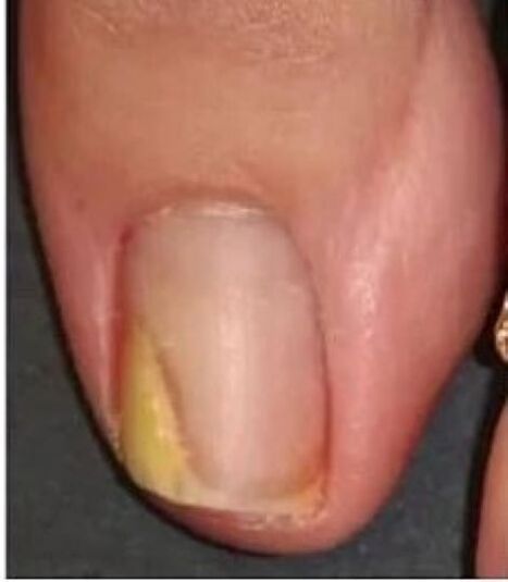 unghia del piede con funghi prima del trattamento