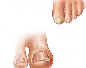 progressione del fungo dell'unghia del piede