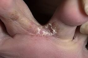 sintomi di funghi ai piedi
