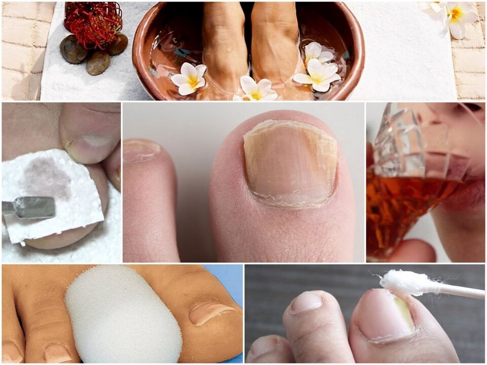 trattamento naturale per i funghi delle unghie