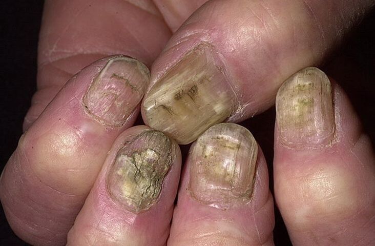Deformazione, separazione e sgretolamento delle unghie a causa dei funghi