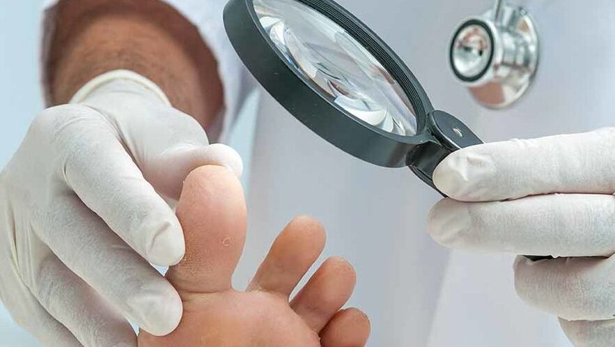 La diagnosi del fungo dell'unghia del piede viene effettuata da un dermatologo