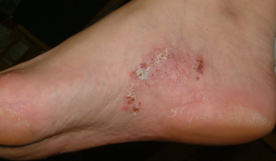Manifestazioni di un'infezione fungina sul piede